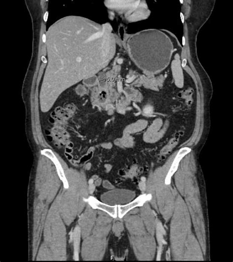 Cureus Lemmel Syndrome As A Rare Cause Of Prolonged Right