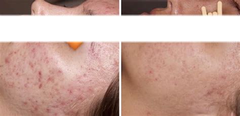 acne therapy in portland luxe laser