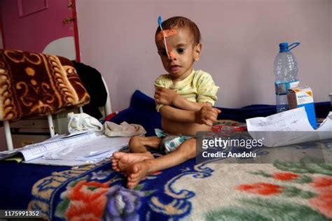 Malnourished Baby Photos And Premium High Res Pictures Getty Images