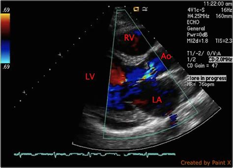Neisseria Elongata Endocarditis Of A Native Aortic Valve Bmj Case Reports