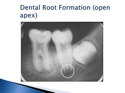 PPT EO 005 06 Normal Intraoral Radiographic Anatomy PowerPoint