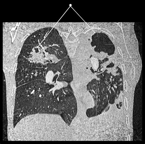 Advanced Lung Tuberculosis Ct Scan Reconstruction Stock Photo Image