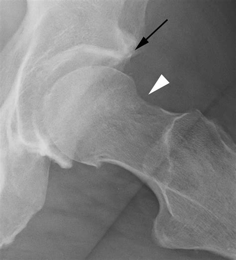 Management Of Incarcerating Pincer Type Femoroacetabular Impingement