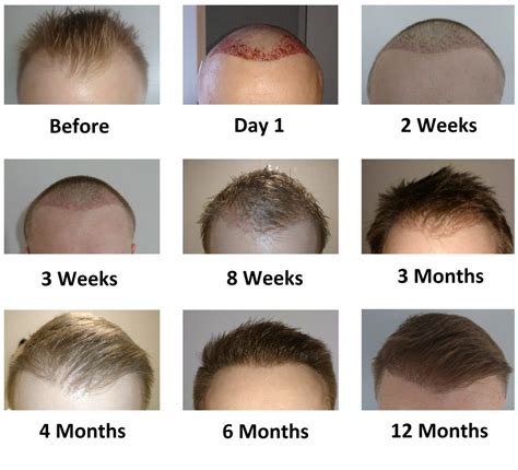 FUE Post Op Overview Hair Transplant Story