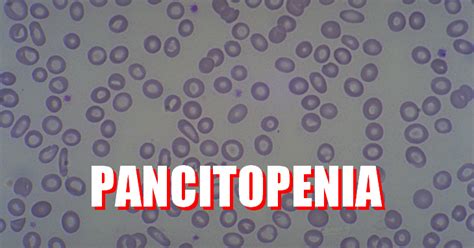 Pancitopenia Definição E Principais Causas Algoritmo De Investigação