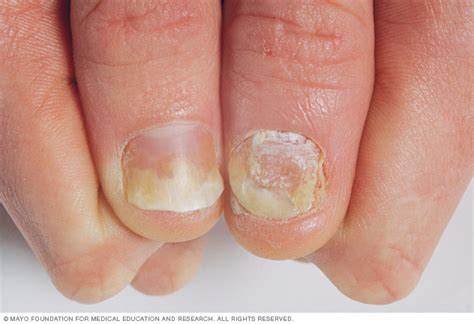 Psoriasis On The Nails Mayo Clinic