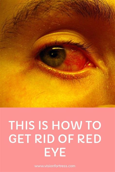 How To Get Rid Of Red Eye Eye Health What Causes Red Eyes Red Eye