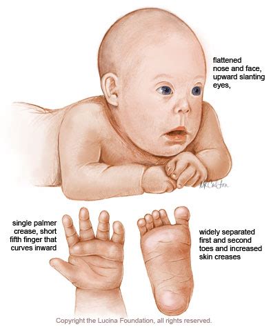 They determine how a baby's body forms during pregnancy and how the baby's body functions as it grows in the womb and after birth. Down Syndrome. Causes, symptoms, treatment Down Syndrome