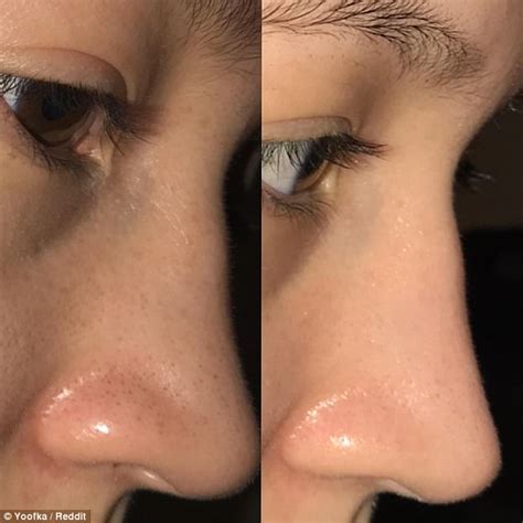 Reddit User Cured Her Blackheads In Just Four Weeks Daily Mail Online