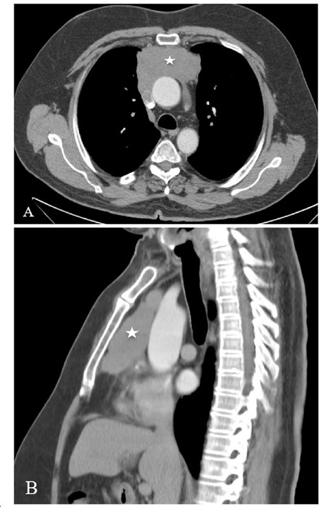 Chest Ct Scan With Contrast Coronal View Mediastinal Window Showing A