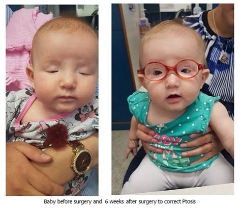 Ptosis Surgery At Hadassah Saves Sight Of Four Month Old Infant