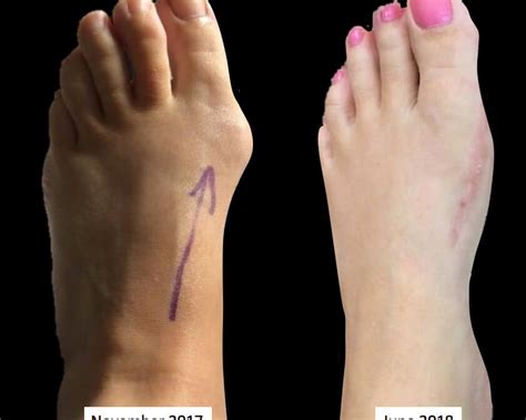 The Bunion Hallux Valgus Deformity Number One Consulting Footpain