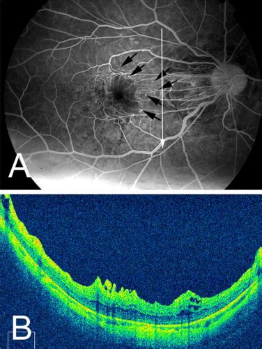 Retinal Vessels And High Myopia Ophthalmology