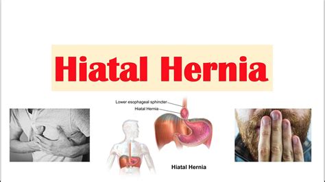 Hiatal Hiatus Hernia Risk Factors Types Signs And Symptoms