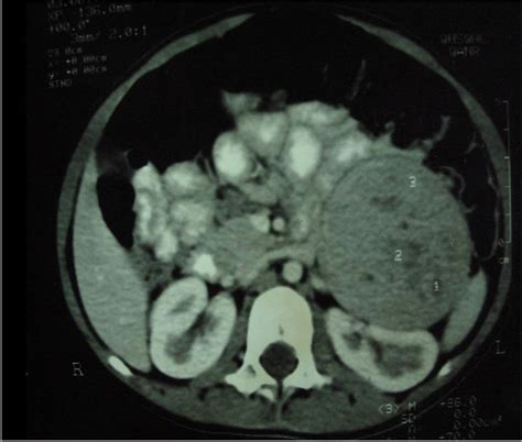 Clinical Examination Showing Clitoromegaly And Pubic Hair There Were