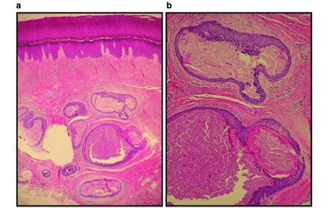 Histologic Appearance Of The Lesion A A Group Of Cystically Dilated