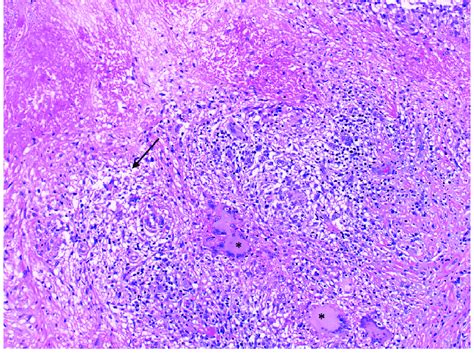 Chronic Granulomatous Inflammation Demonstrated By Necrosis Arrow