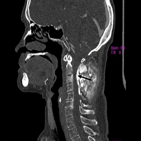 Axial Ct Bone Window With Contrast Of The Upper Neck Shows A Tumor