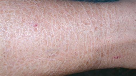 Rashes And Skin Conditions Associated With Hiv And Aids