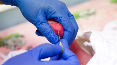 Rapid Result Test On Track To Transform Sickle Cell Disease Screening
