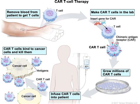 T Cell Transfer Therapy Immunotherapy Nci