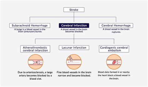 The blockage reduces the blood flow and. Ischemic stroke | Healios K.K.