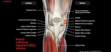 Medial Collateral Ligament Injury Carolyn Tucker
