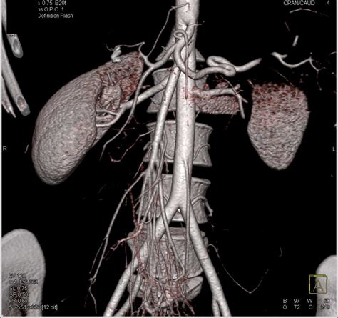 Superior Mesenteric Artery Sma Syndrome With Narrowed Sma Angle