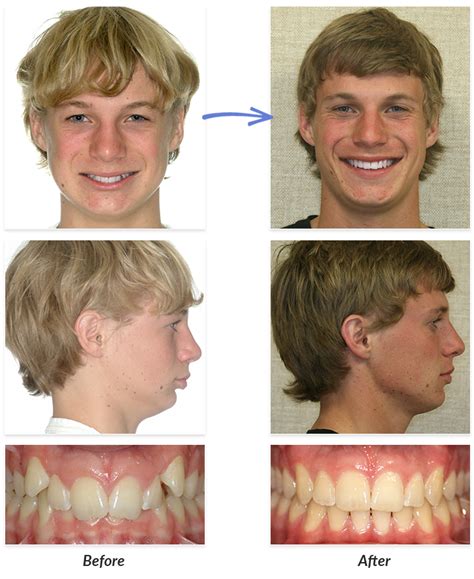 Before And After Braces Photos Delurgio Orthodontics