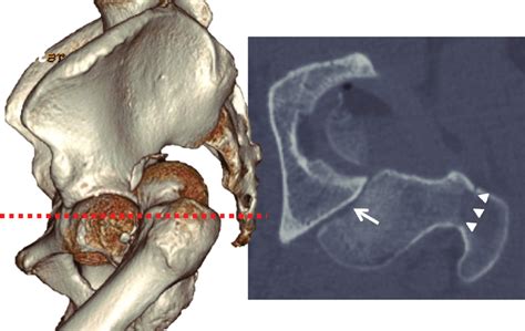 Pre Operative Axial Ct Scans Of The Pelvis Showing Fracture Dislocation