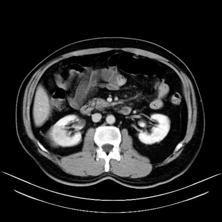 As can be seen in. Renal cell carcinoma | Image | Radiopaedia.org