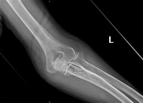 Olecranon Fractures Treatment Management Approach Considerations My