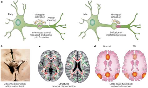 Diffuse axonal injury after traumatic cerebral microbleeds: Diffuse Axonal Injury - Neurology - Medbullets Step 2/3