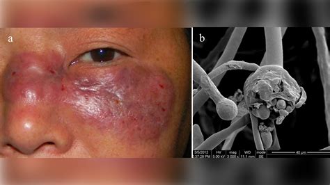 That may be due to the rapid spread of the delta or b.1.617.2 variant of the virus. Mucormycosis Causes, Symptoms, Risks, Diagnosis ...