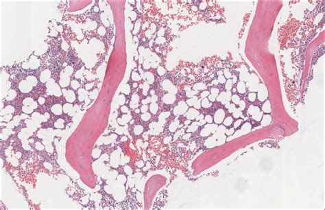 Bone Marrow Normal Histology Nus Pathweb Nus Pathweb