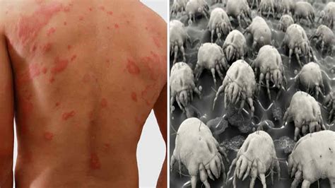 They live off dead human skin, and your bedding is where they hang dust mite allergies are even grosser than many people realize. Dust Mites In Your Bed Are Making You Sick, KILL Them With ...