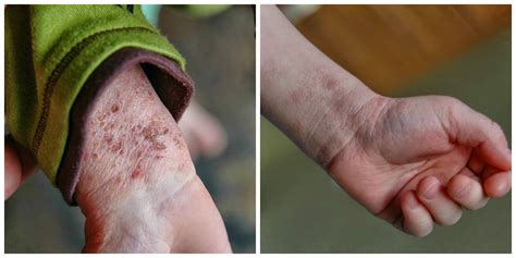 Klines Road From Out Of Control Eczema To Topical Steroid Withdrawal