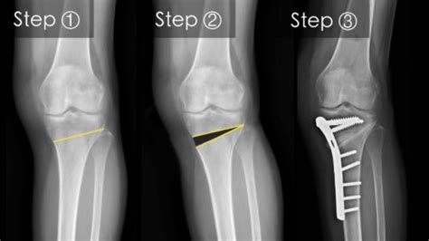 Cosm High Tibial Osteotomy With Or Without Acl Reconstruction