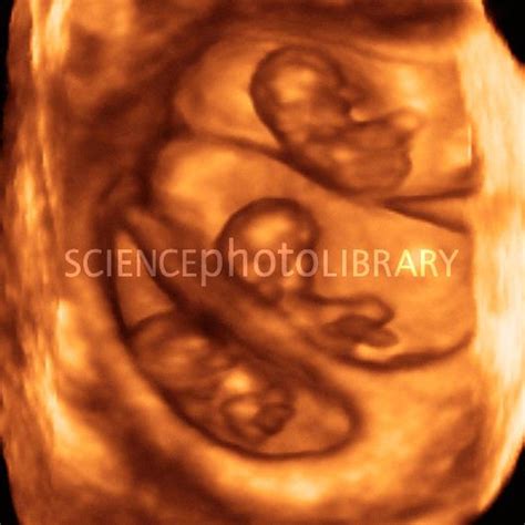 Triplets Ultrasound Triplets Triplet Babies