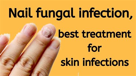 Nail Fungal Infection Nail Infection Best Treatment For Skin
