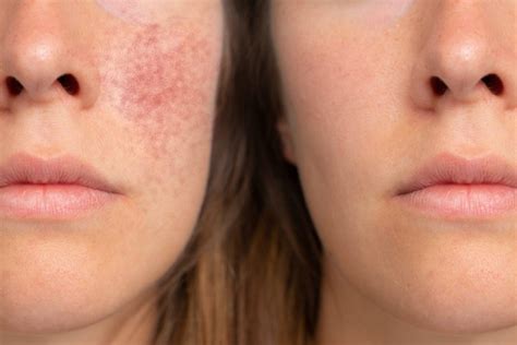 Rosacea Awareness Month What Aesthetic Treatments Help Rosacea