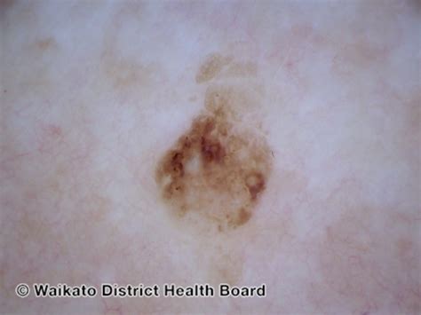 Fileseborrhoeic Keratosis Polarised Dermoscopy View Dermnet Nz Seb K