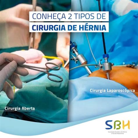 Conheça Dois Tipos De Cirurgia De Hérnia Sbh