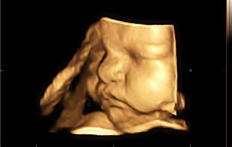 Ultrasound Pic Nose So Big June 2018 Babies Forums What To Expect