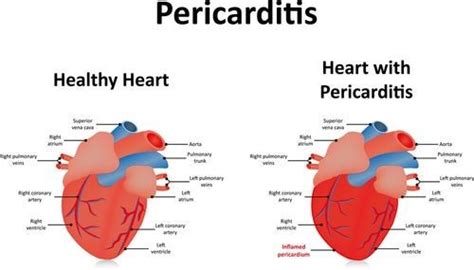 Pericarditis is inflammation of the pericardium (the fibrous sac surrounding the heart). Pericardite: sintomas, causas e tratamento - Melhor com Saúde