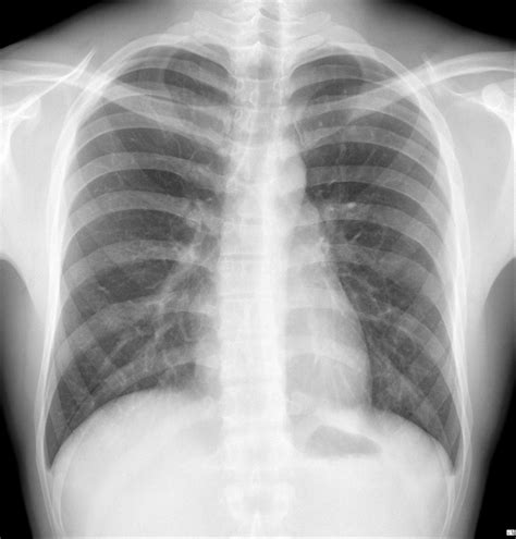 Anatomy Of Chest X Ray