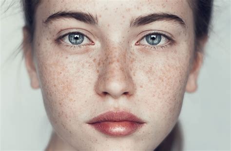 10 Things To Know To Eliminate Facial Melasma Nida Esth