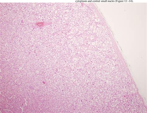 Figure 13 From A Case Report Of Cortisol Secreating Adrenal Adenoma