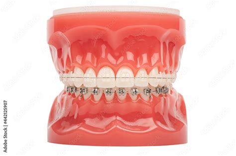 Orthodontic Model Demonstration Teeth Model Of Orthodontic Bracket Or