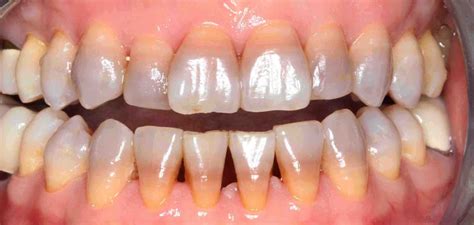 Tooth Discoloration What Does It Mean And What Causes It